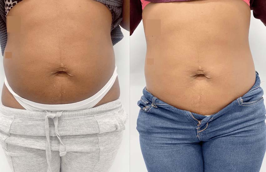 PhysiQ-before-and-after_04