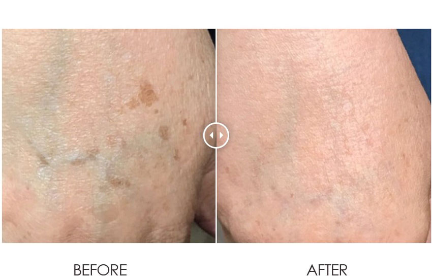 PicoLazer_beforeafter_02-web