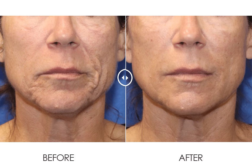 Pixel8-RF_beforeafter_01-web