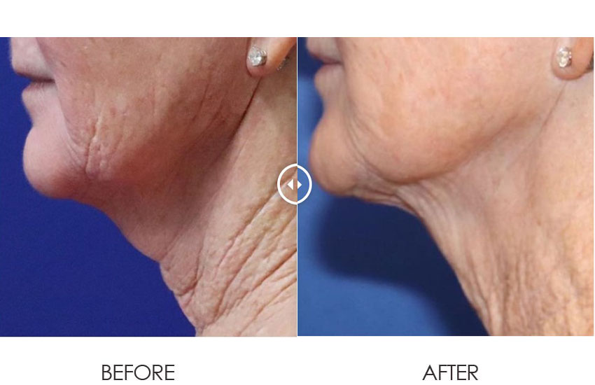 Pixel8-RF_beforeafter_03-web