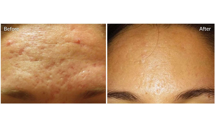 SkinPen_beforeafter_02-web