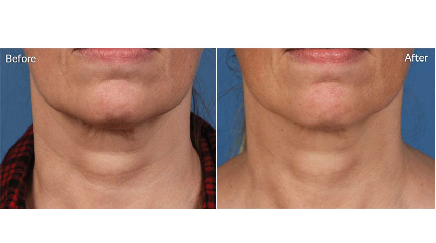 SkinPen_beforeafter_03-web